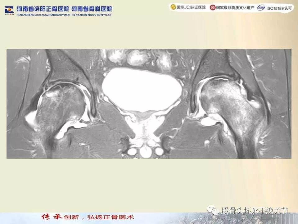 髋臼盂唇损伤的MRI诊断