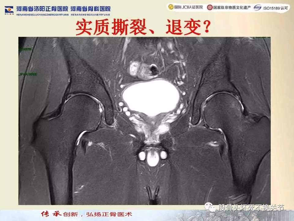 髋臼盂唇损伤的MRI诊断