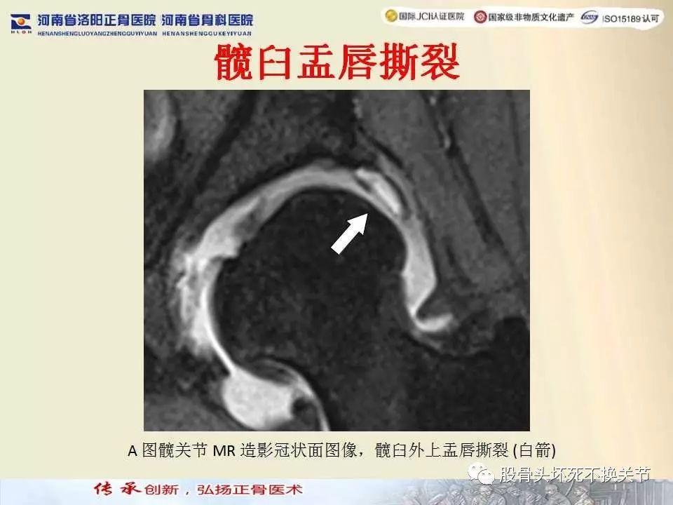 髋臼盂唇损伤的MRI诊断