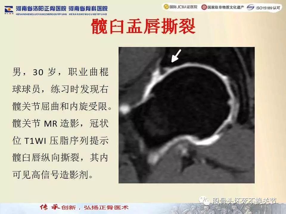 髋臼盂唇损伤的MRI诊断