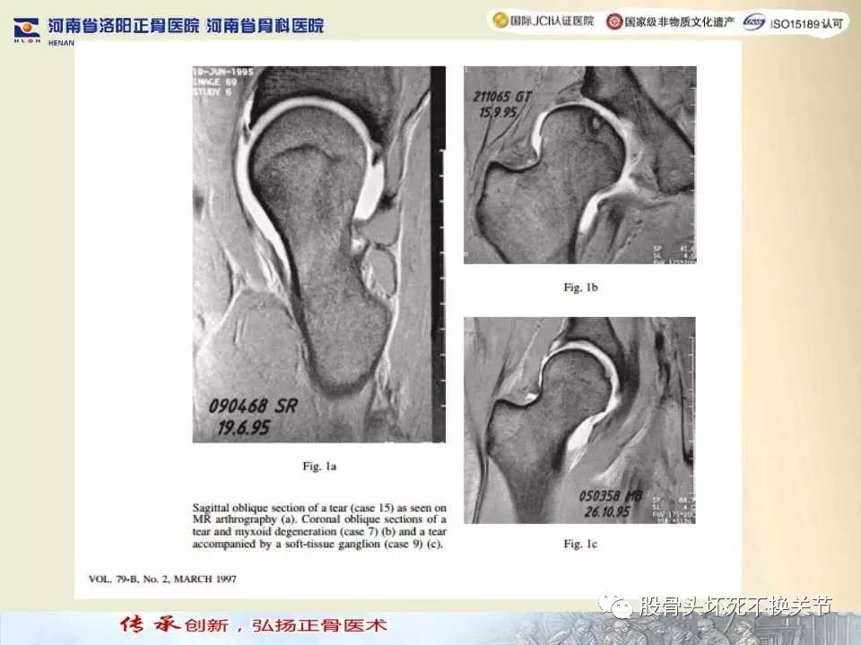 髋臼盂唇损伤的MRI诊断