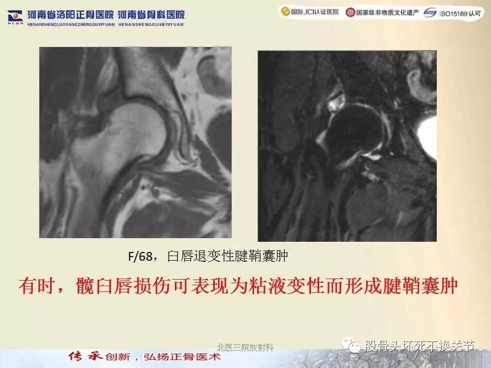 髋臼盂唇损伤的MRI诊断