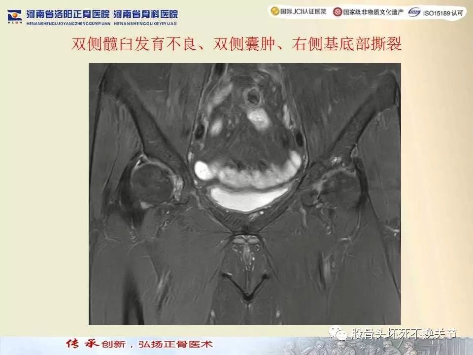 髋臼盂唇损伤的MRI诊断