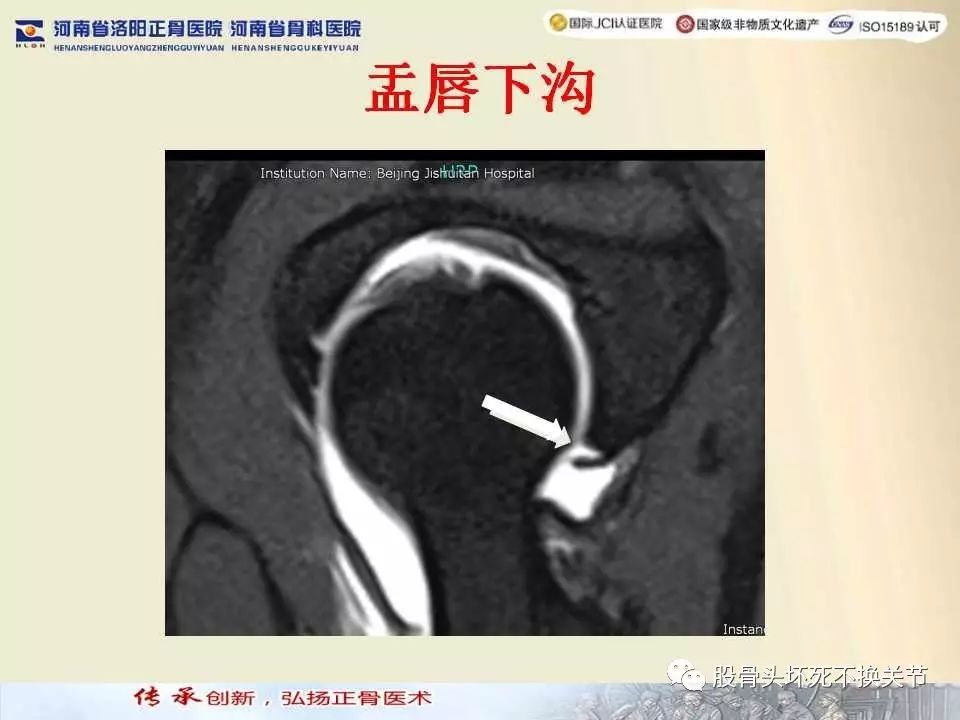 髋臼盂唇损伤的MRI诊断