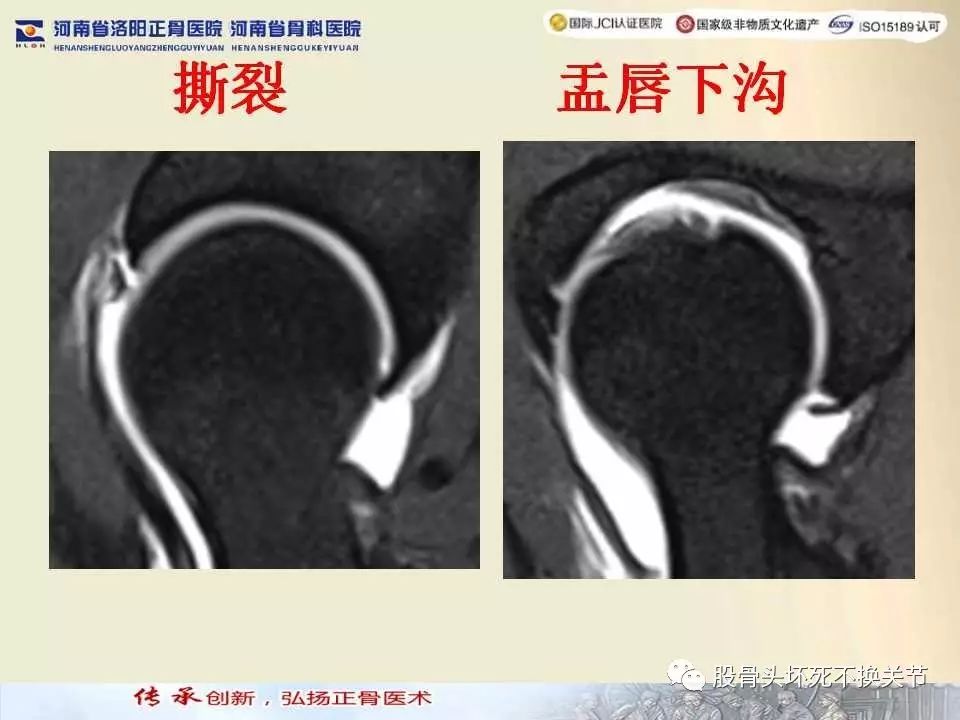 髋臼盂唇损伤的MRI诊断