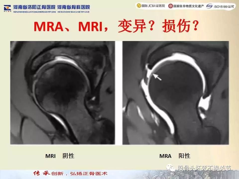 髋臼盂唇损伤的MRI诊断