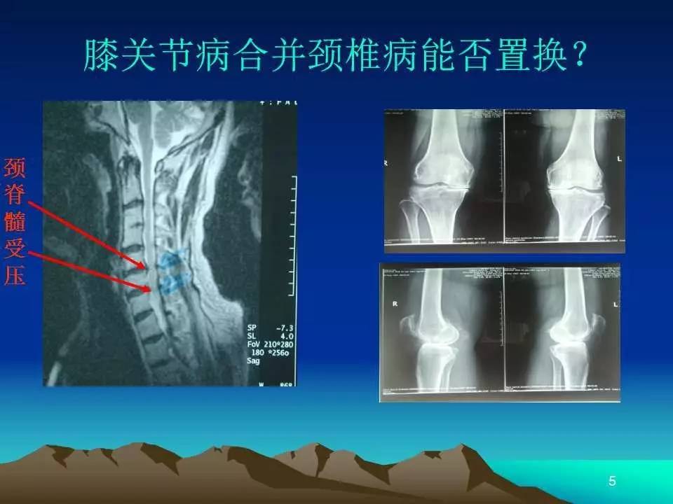 膝关节置换基础理论的临床应用