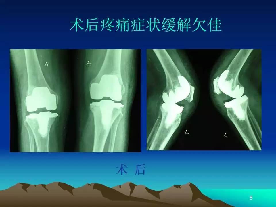 膝关节置换基础理论的临床应用