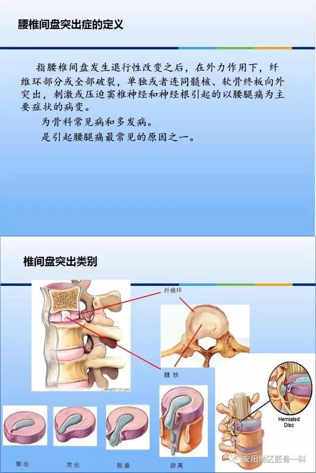 经椎间孔镜微创治疗腰椎间盘突出症