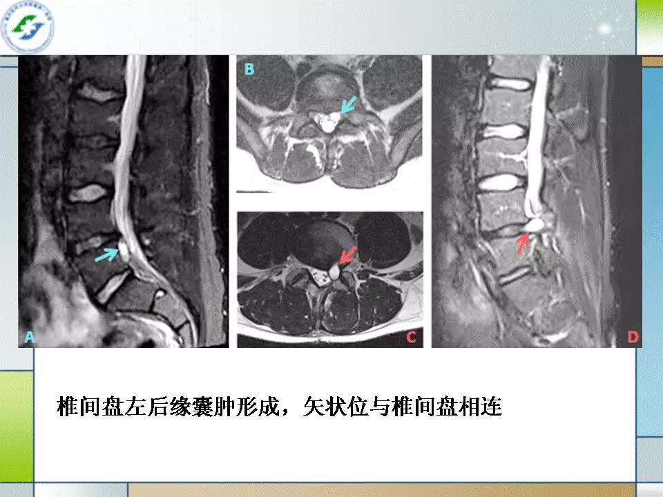 脊柱退变的影像诊断技巧