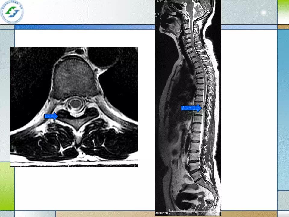脊柱退变的影像诊断技巧