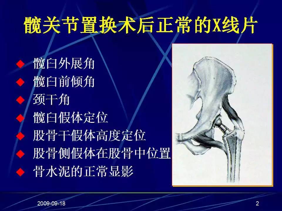 髋关节置换手术技巧及并发症的防范