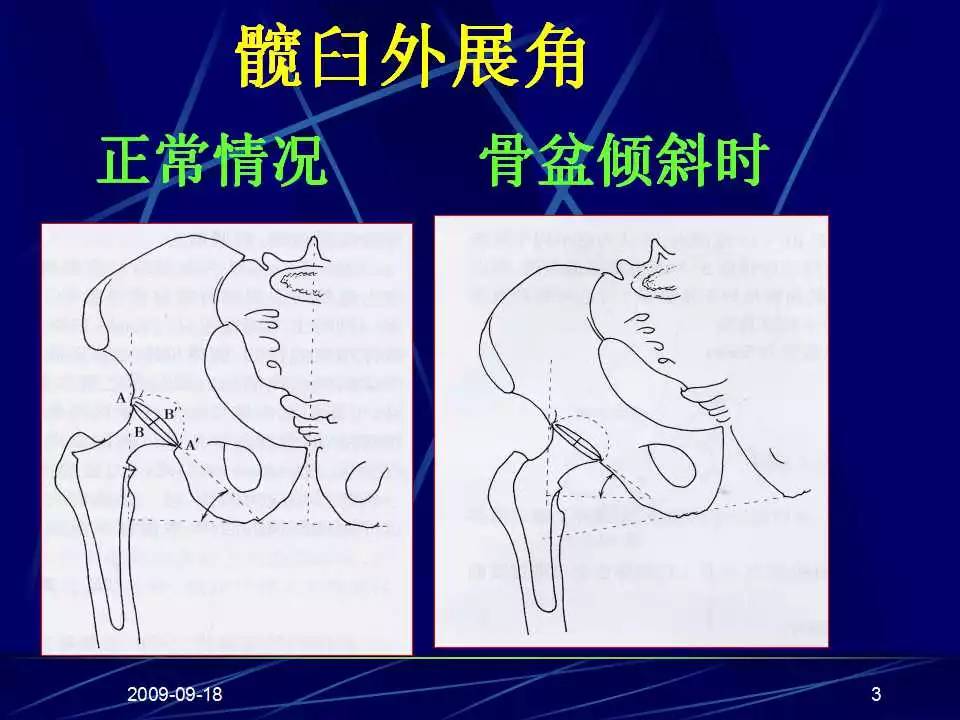 髋关节置换手术技巧及并发症的防范