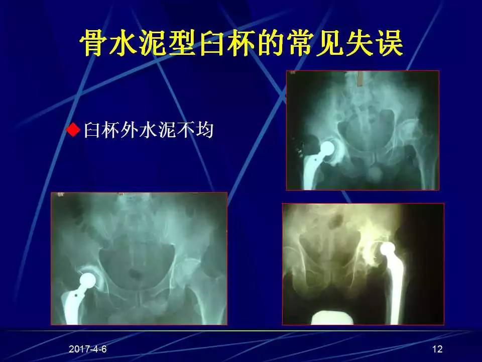 髋关节置换手术技巧及并发症的防范