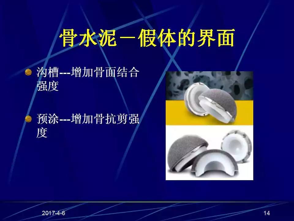 髋关节置换手术技巧及并发症的防范