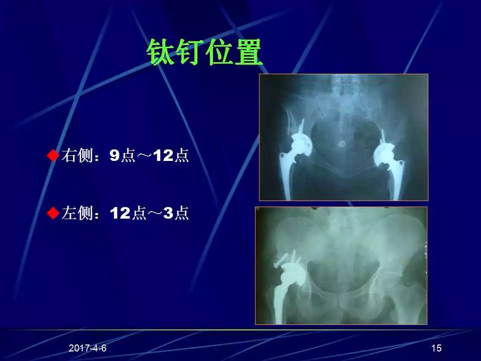 髋关节置换手术技巧及并发症的防范