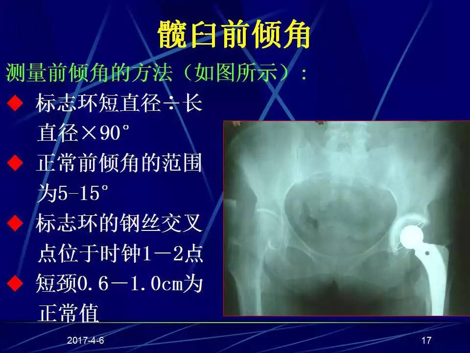 髋关节置换手术技巧及并发症的防范