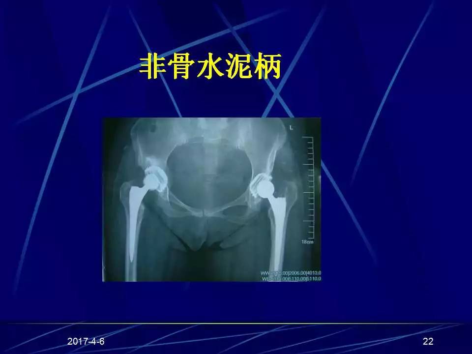 髋关节置换手术技巧及并发症的防范