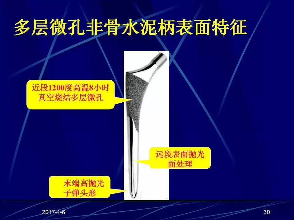 髋关节置换手术技巧及并发症的防范