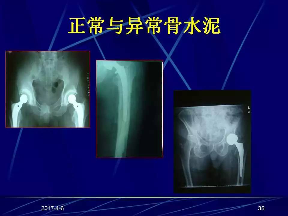 髋关节置换手术技巧及并发症的防范