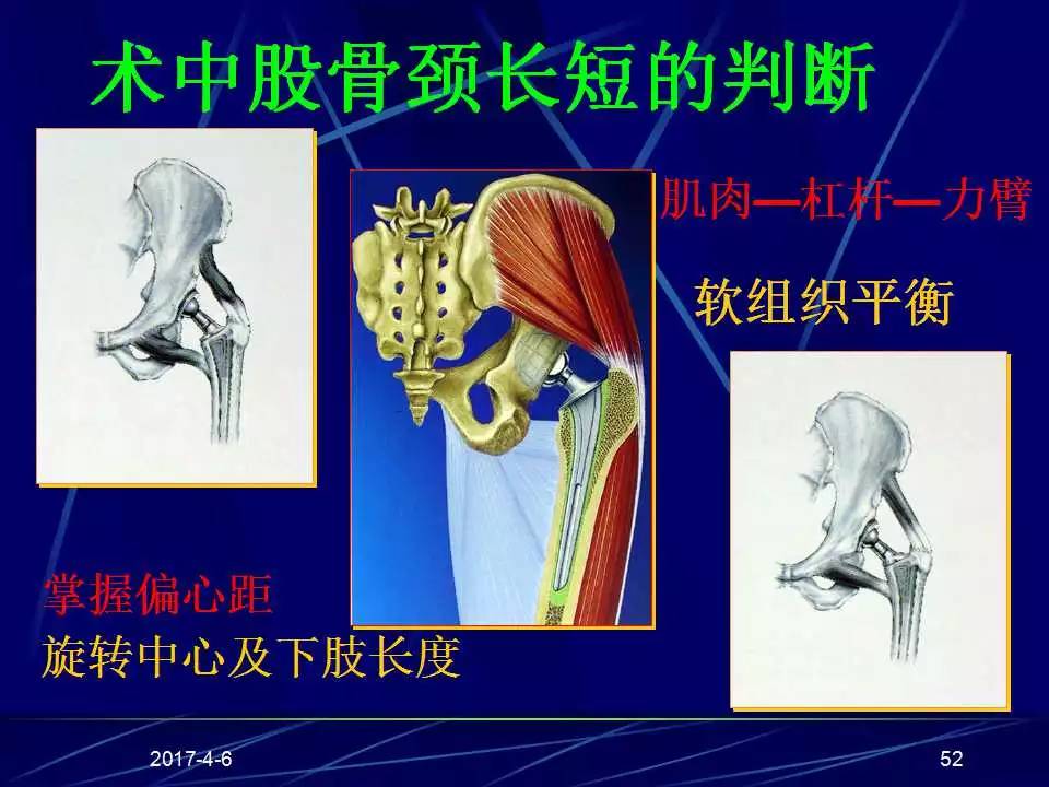 髋关节置换手术技巧及并发症的防范