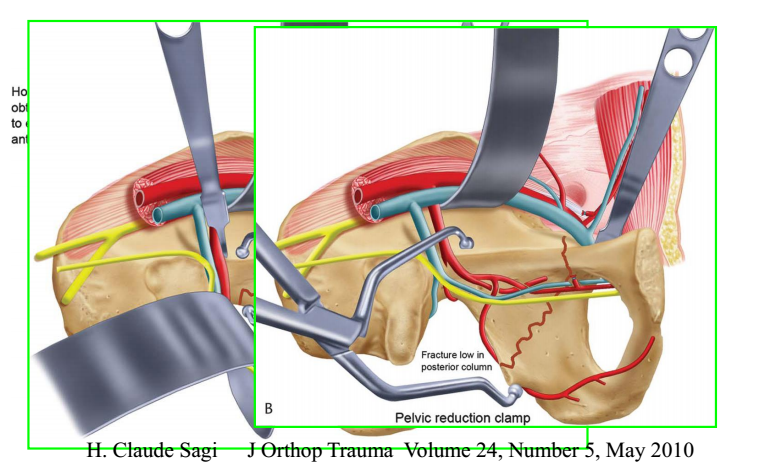 骨盆髋臼骨折的手术入路及步骤