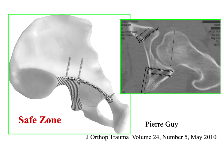 骨盆髋臼骨折的手术入路及步骤