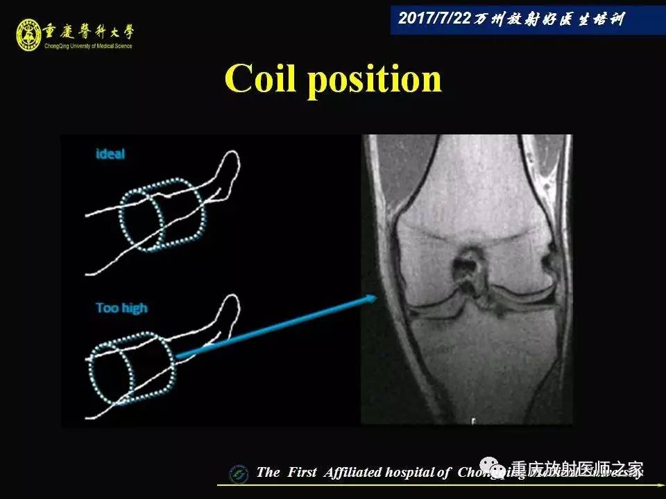 膝关节损伤的MRI诊断技巧