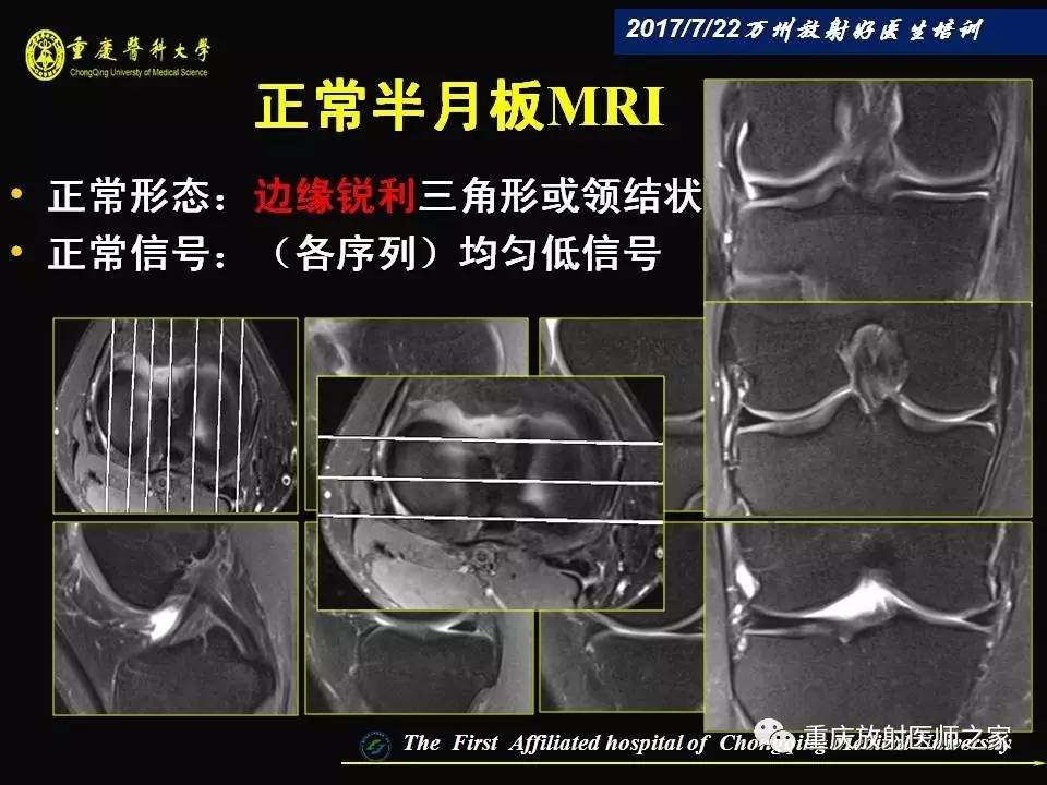 膝关节损伤的MRI诊断技巧