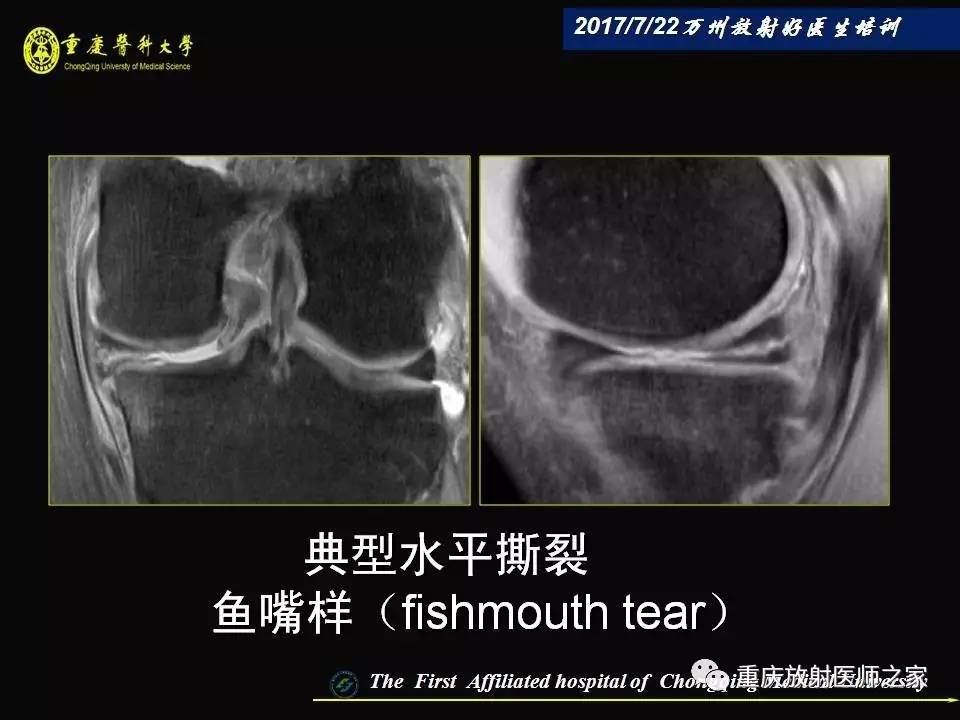 膝关节损伤的MRI诊断技巧