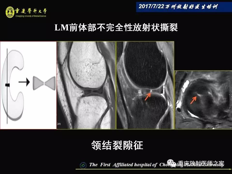 膝关节损伤的MRI诊断技巧