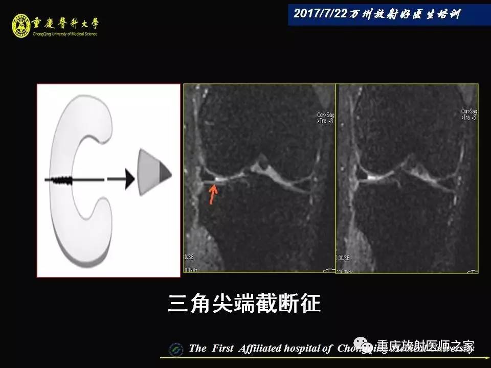 膝关节损伤的MRI诊断技巧