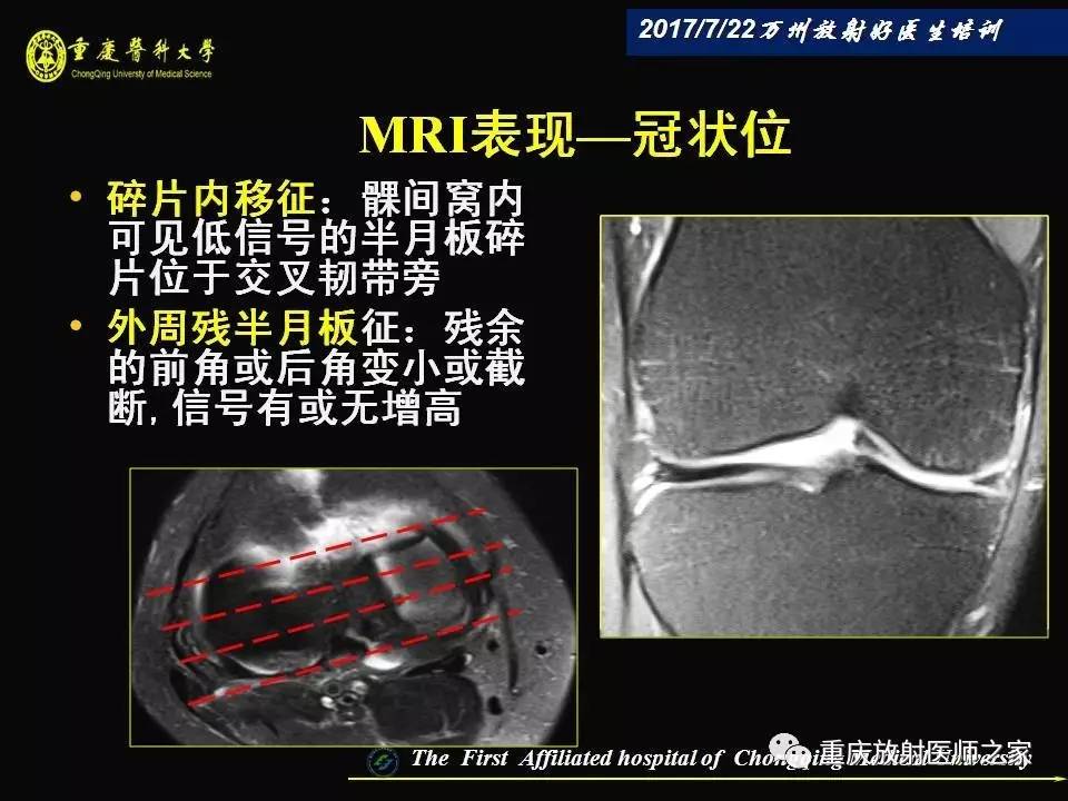 膝关节损伤的MRI诊断技巧