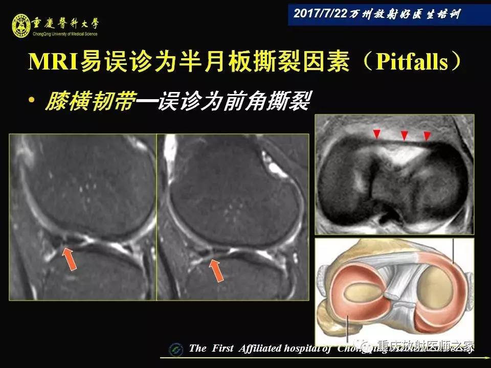 膝关节损伤的MRI诊断技巧