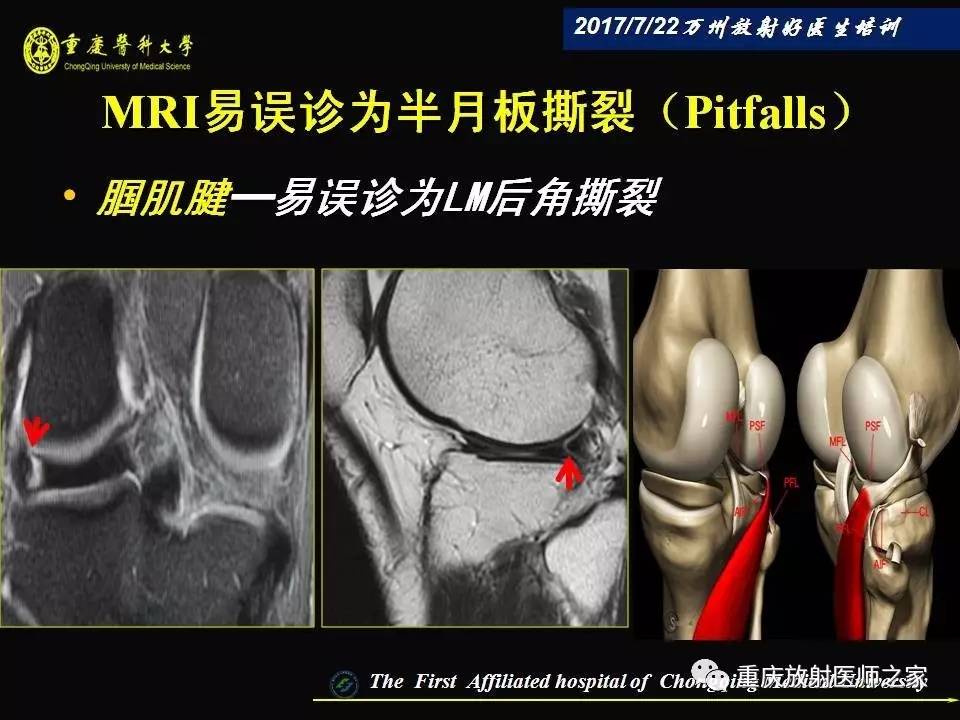 膝关节损伤的MRI诊断技巧