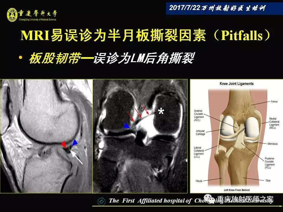 膝关节损伤的MRI诊断技巧