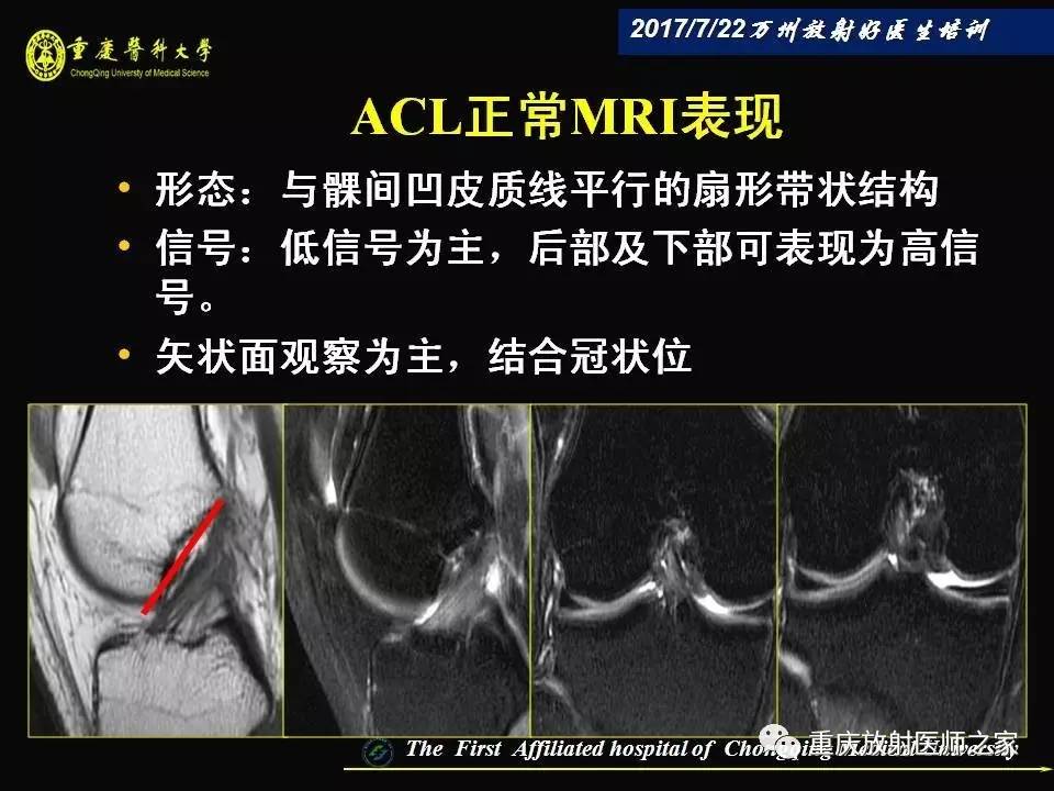 膝关节损伤的MRI诊断技巧