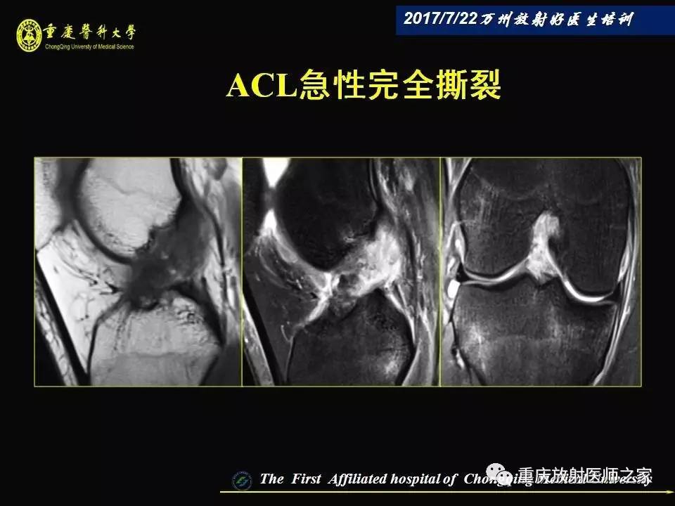 膝关节损伤的MRI诊断技巧