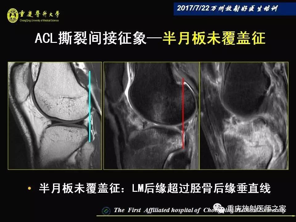 膝关节损伤的MRI诊断技巧