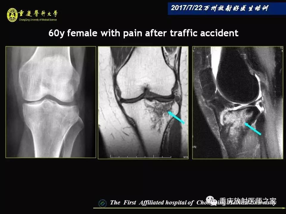 膝关节损伤的MRI诊断技巧