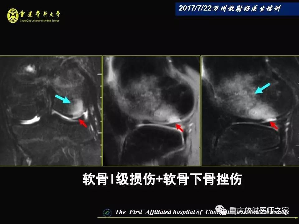 膝关节损伤的MRI诊断技巧