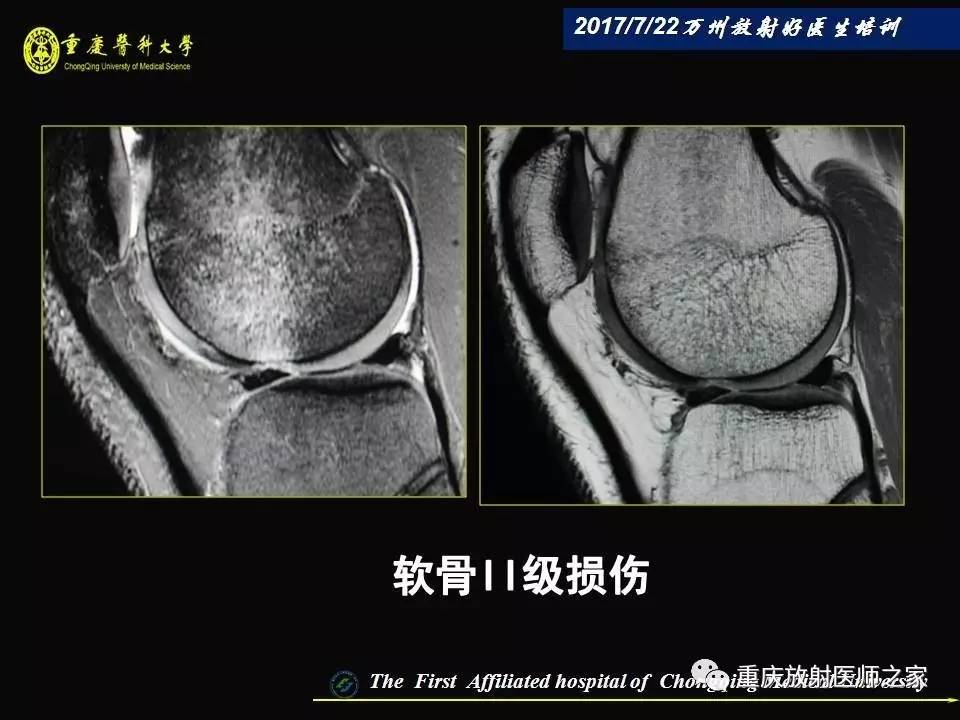膝关节损伤的MRI诊断技巧