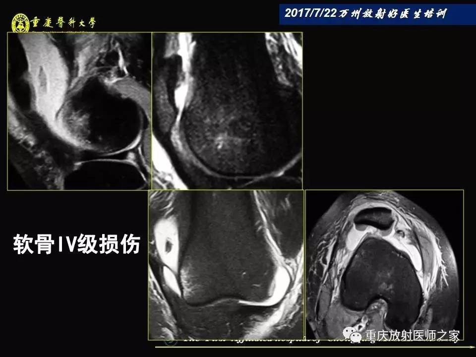 膝关节损伤的MRI诊断技巧