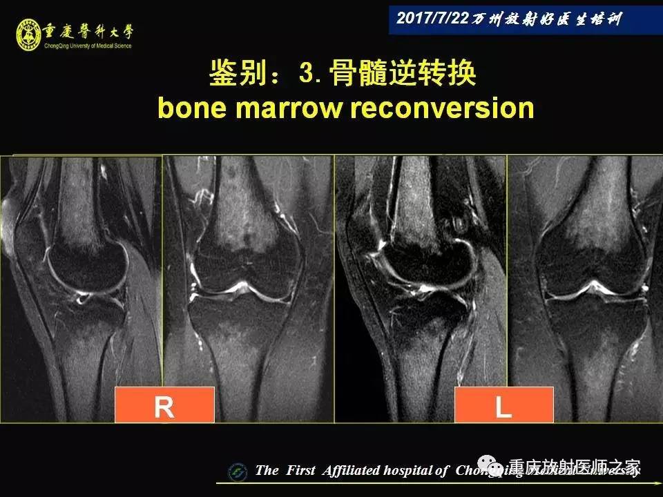 膝关节损伤的MRI诊断技巧