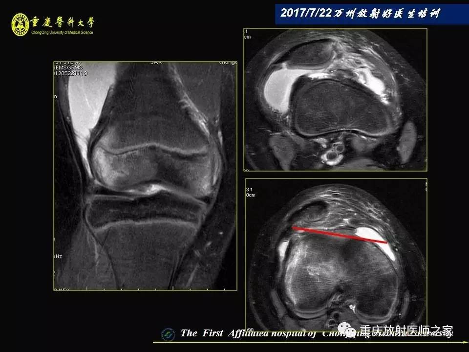 膝关节损伤的MRI诊断技巧