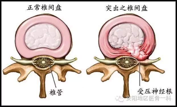 关于腰椎间盘突出症的十个问题