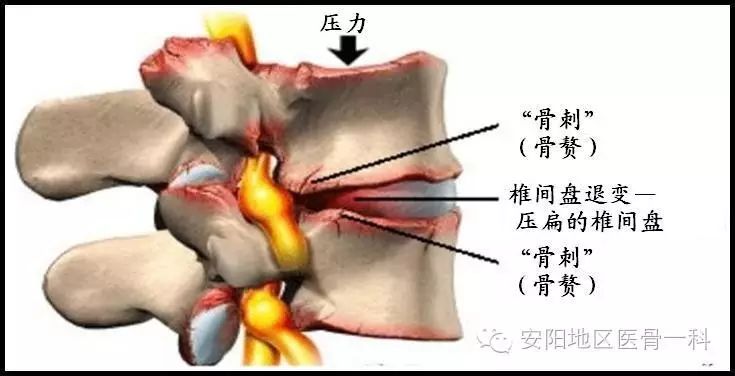 关于腰椎间盘突出症的十个问题