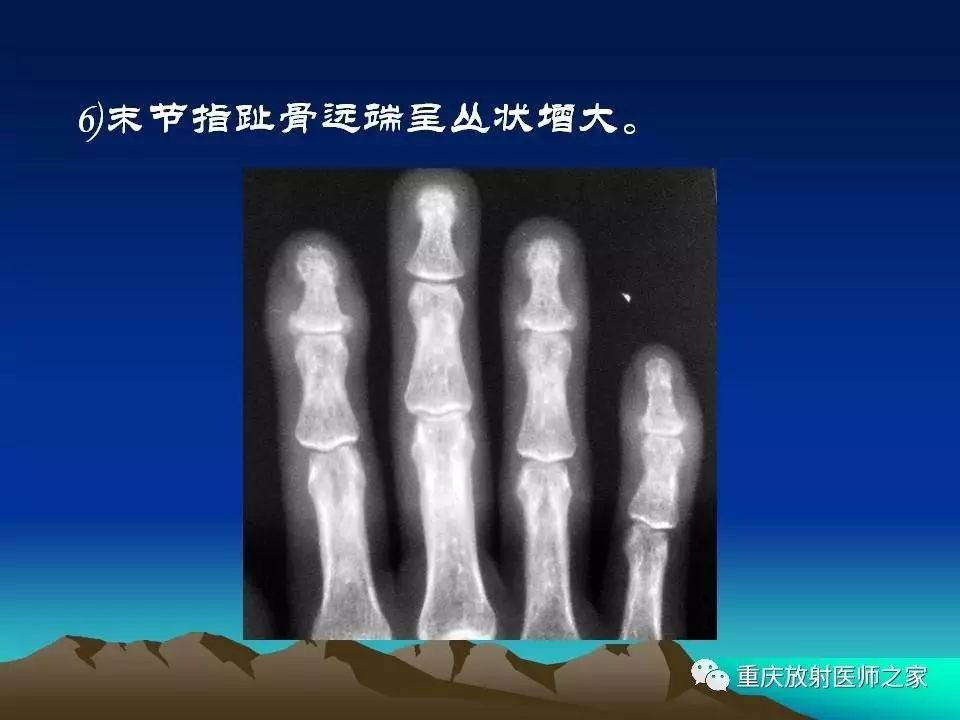 四肢小关节病变的影像诊断