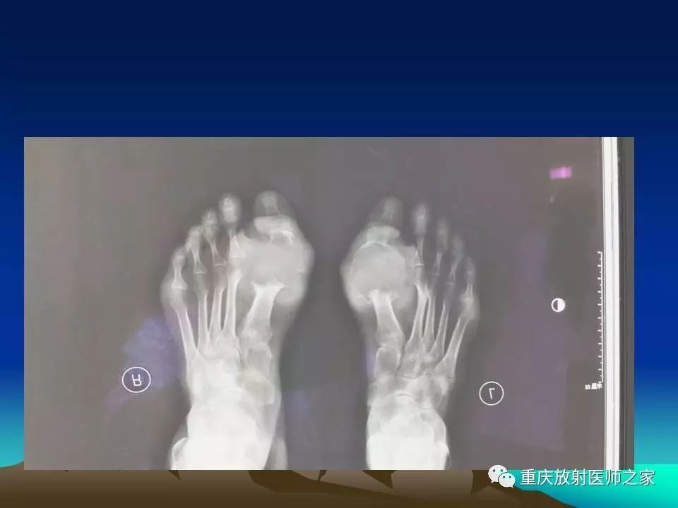 四肢小关节病变的影像诊断
