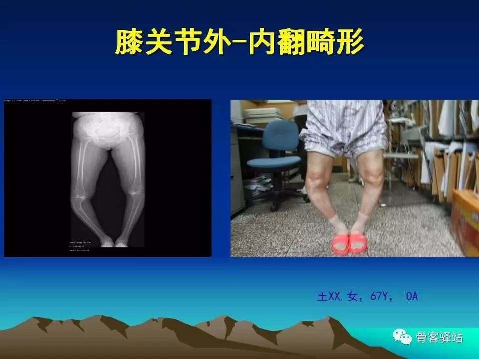 复杂性膝关节置换术的处理策略